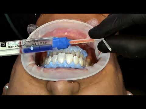 SDI Pola Rapid Advanced Tooth Whitening System - 2