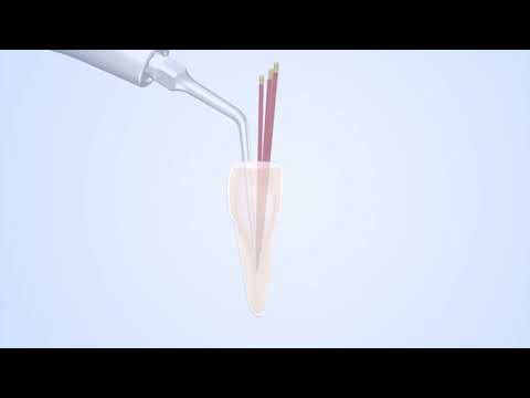 Woodpecker Scaler Tip E3 for UDS & EMS Scalers - 2