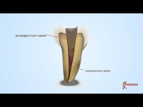 Woodpecker Scaler Tip ED1 for DTE & Satelec Scalers - 2