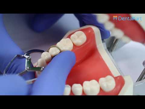 ET Dental Wooden Wedges Kit - 2