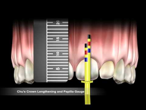 Hu-Friedy Chu'S Crown Lengthening Gauge (CLG) - 2